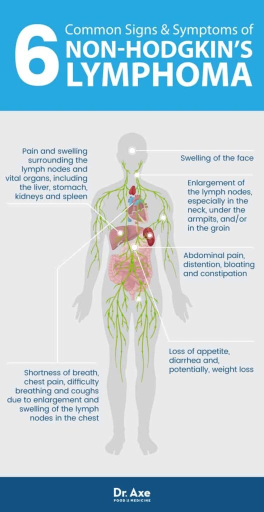 Risk Factors And Precautions For Non-Hodgkins Lymphoma Risk Factors And Precautions For Non-Hodgkins Lymphoma