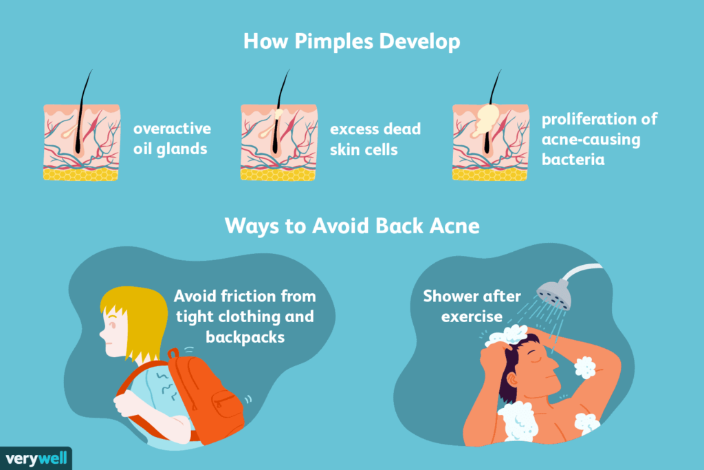 Risk Factors And Precautions For Pimples