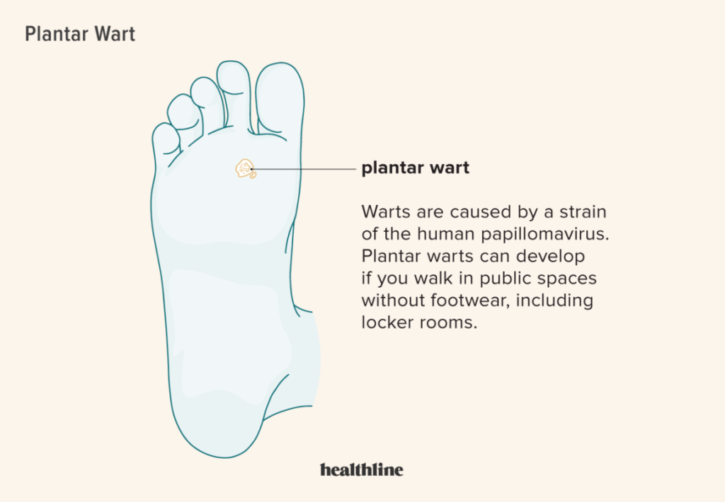 Risk Factors And Precautions For Plantar Warts