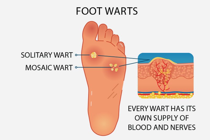 Risk Factors And Precautions For Plantar Warts