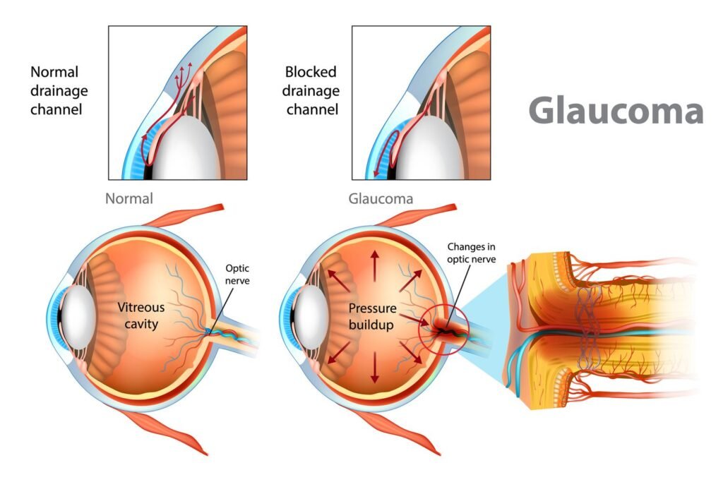 Risk Factors And Precautions For Primary Congenital Glaucoma