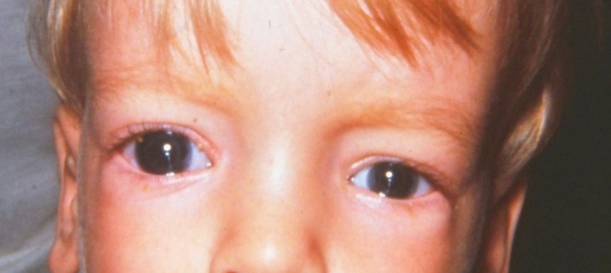 Risk Factors And Precautions For Primary Congenital Glaucoma