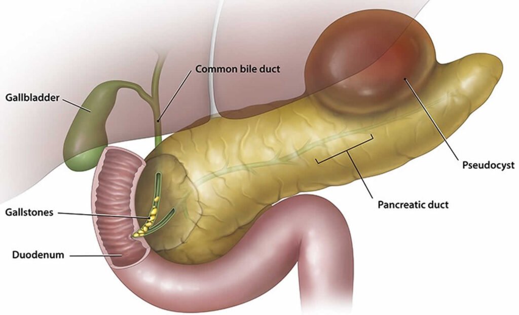Risk Factors And Precautions For Pseudocyst