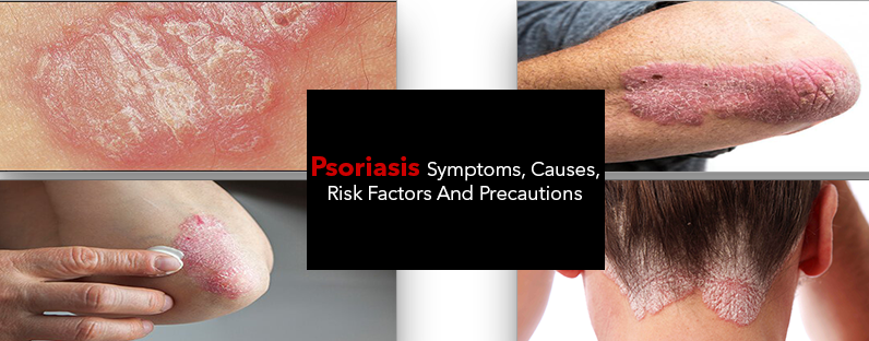 Risk Factors And Precautions For Psoriasis
