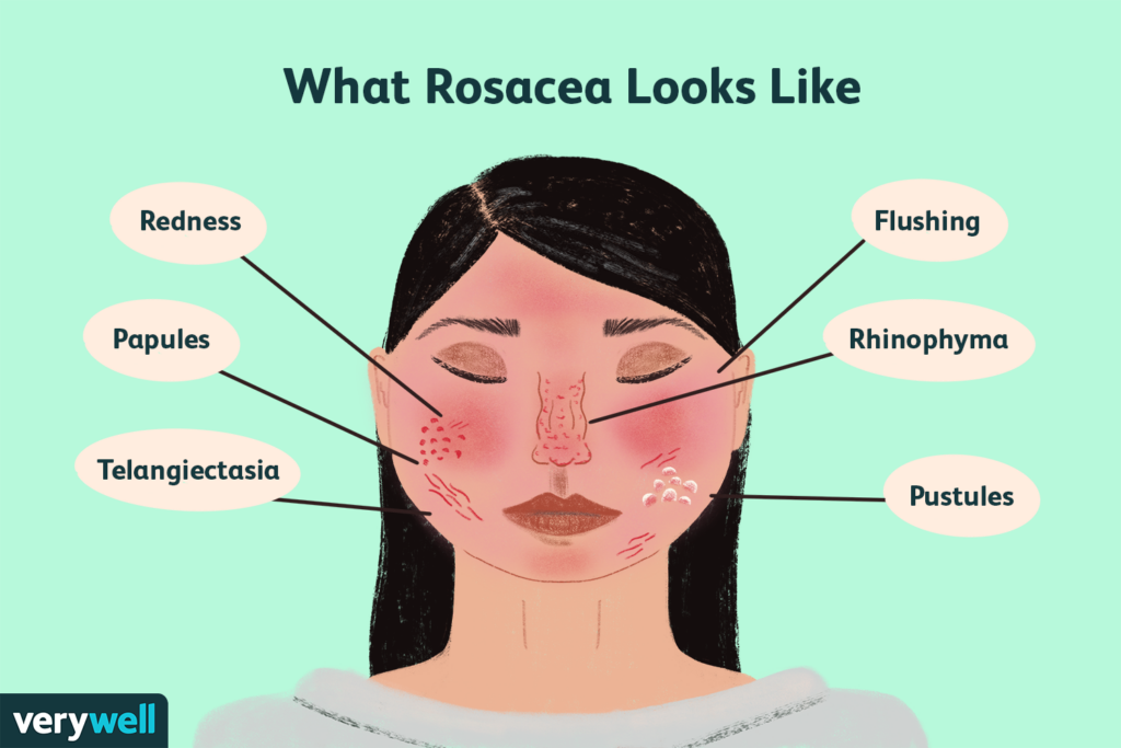 Risk Factors And Precautions For Rosacea