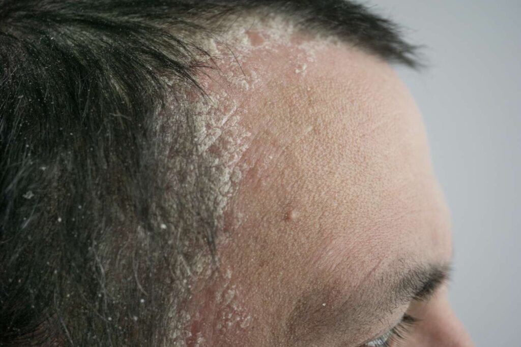Risk Factors And Precautions For Scalp Psoriasis