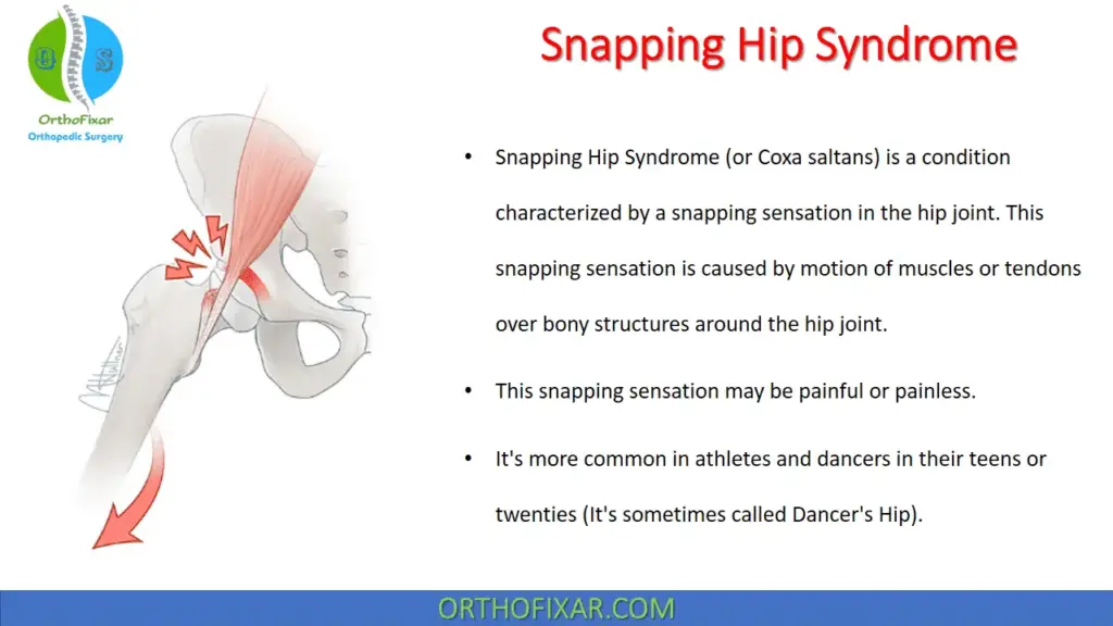 Risk Factors And Precautions For Snapping Hip Syndrome