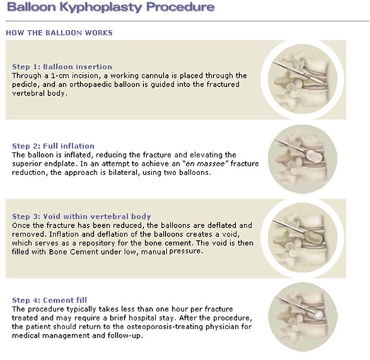 Risk Factors And Precautions For Spinal Fracture