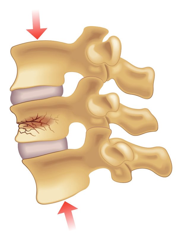 Risk Factors And Precautions For Spinal Fracture