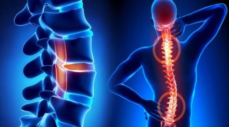 Risk Factors And Precautions For Spine Curvature Disorders