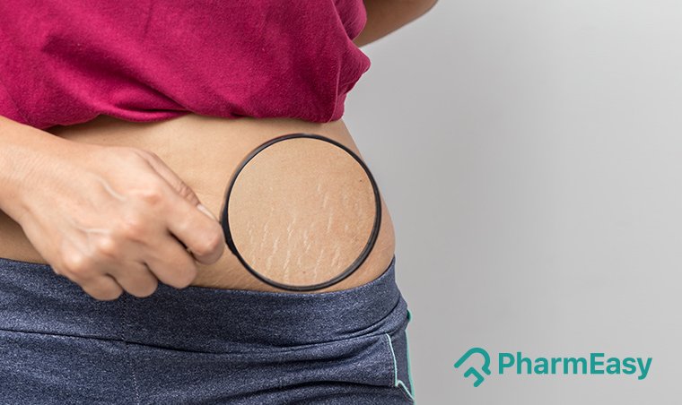 Risk Factors And Precautions For Stretch Marks