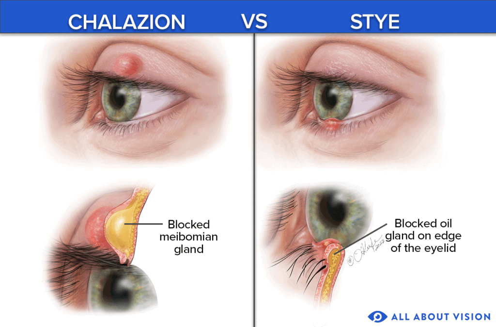 Risk Factors And Precautions For Stye