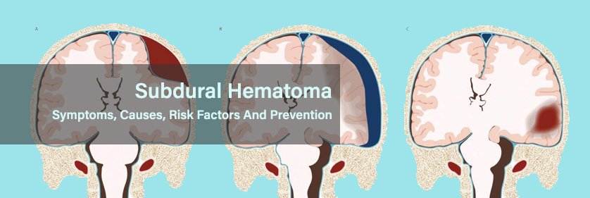Risk Factors And Precautions For Subdural Hematoma