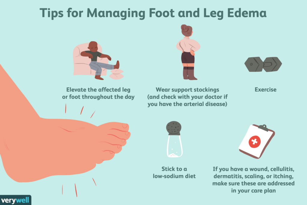 Risk Factors And Precautions For Swollen Feet Or Ankles