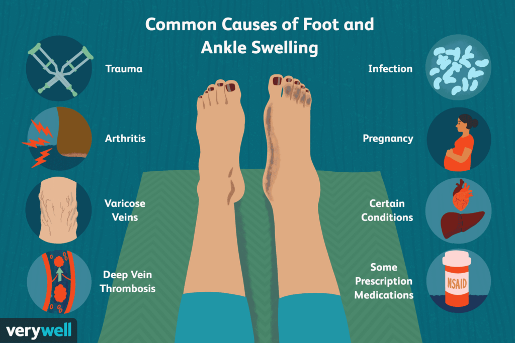 Risk Factors And Precautions For Swollen Feet Or Ankles