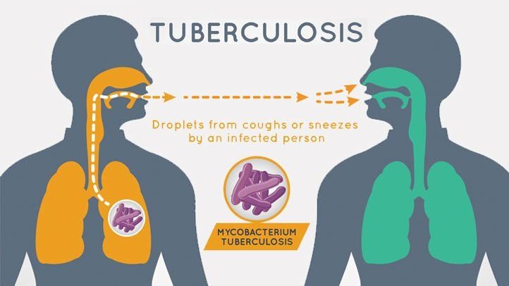 Risk Factors And Precautions For Tubesculosis
