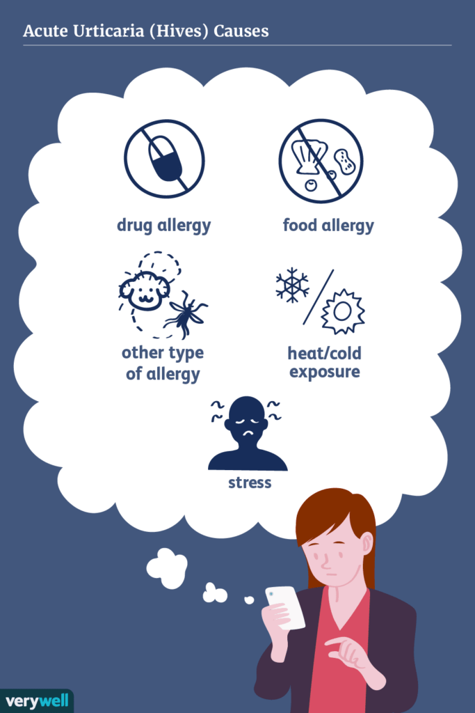 Risk Factors And Precautions For Urticaria