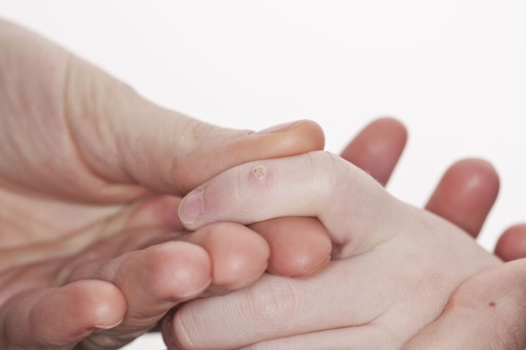 Risk Factors And Precautions For Warts