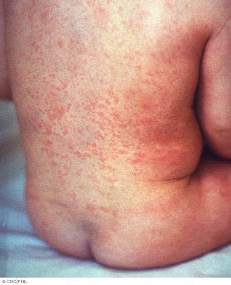 Rubella: Causes, Symptoms, and Treatment