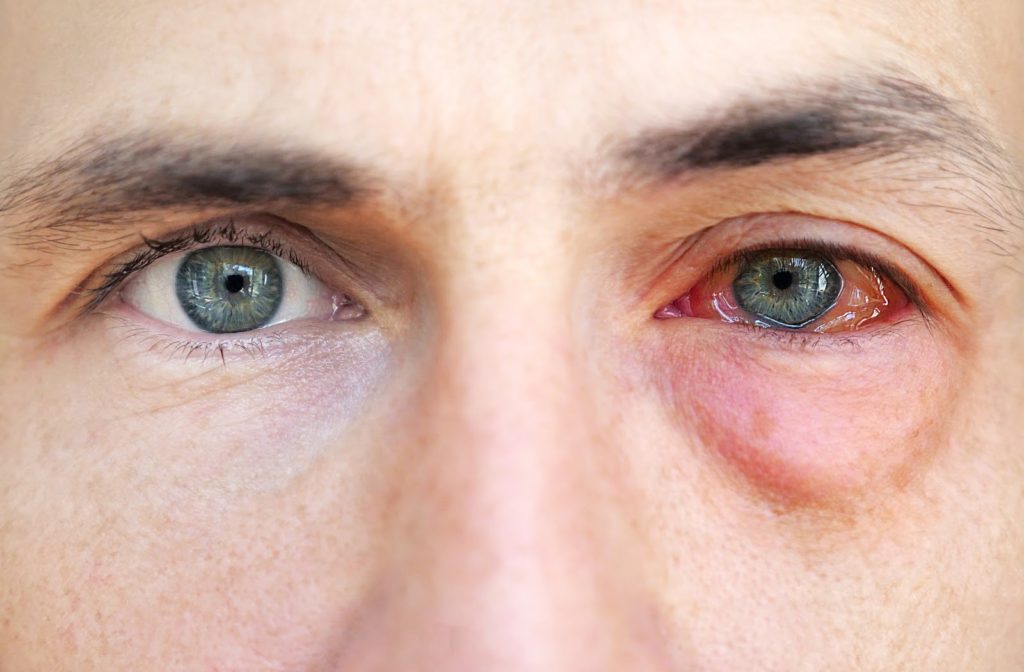 Seasonal Allergies and Conjunctivitis: Minimizing Discomfort and Finding Relief