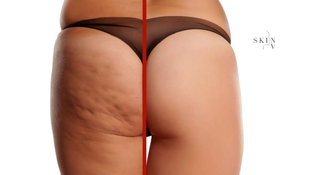 Secrets to Smoother Skin: Say Goodbye to Cellulite