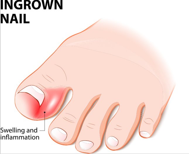 Seeking Relief: Effective Home Remedies for an Ingrown Toenail