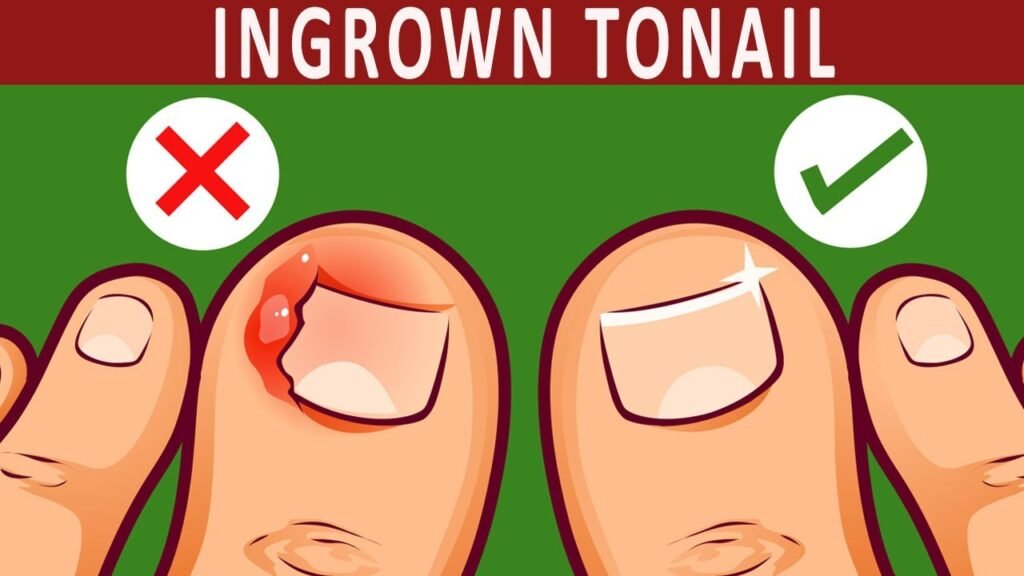 Seeking Relief: Effective Home Remedies for an Ingrown Toenail