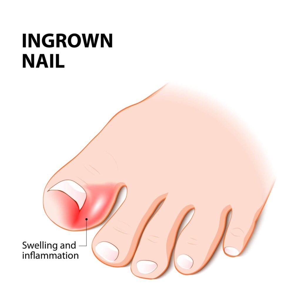 Seeking Relief: Effective Home Remedies for an Ingrown Toenail