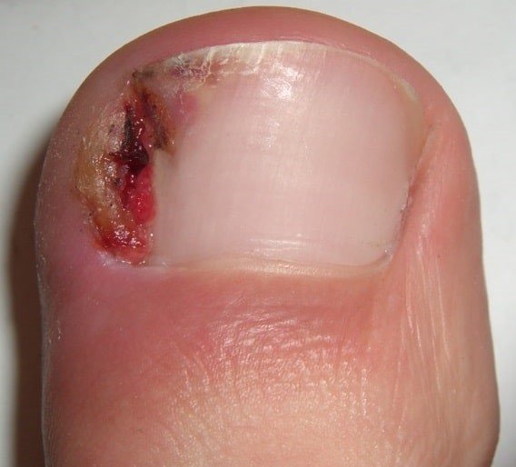 Seeking Relief: Effective Home Remedies for an Ingrown Toenail