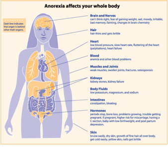 Signs and Symptoms of Anorexia Nervosa