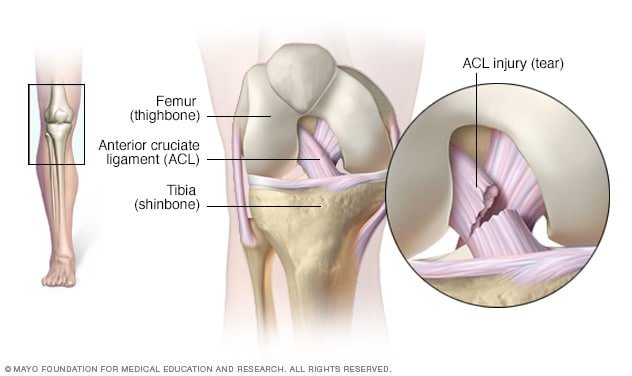 Signs and Symptoms of Anterior Cruciate Ligament (ACL) Injuries
