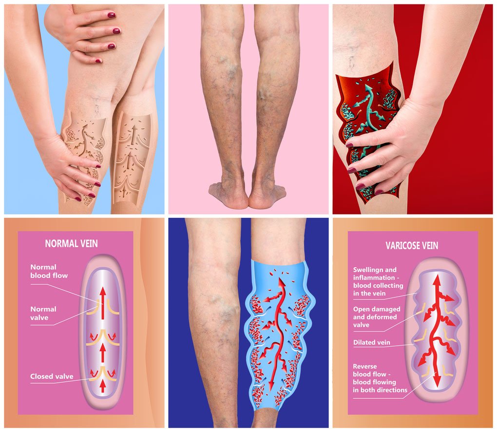 Signs and Symptoms of Deep Vein Thrombosis