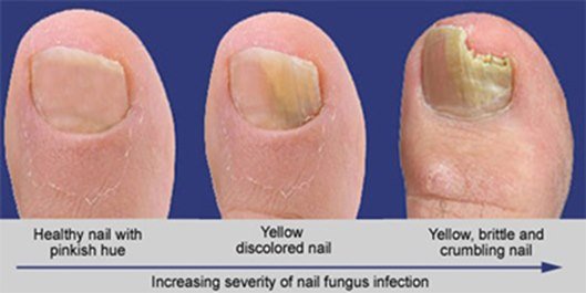 Signs and Symptoms of Fungal Nail Infections