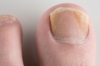 Signs and Symptoms of Fungal Nail Infections