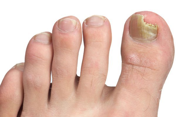 Signs and Symptoms of Fungal Nail Infections