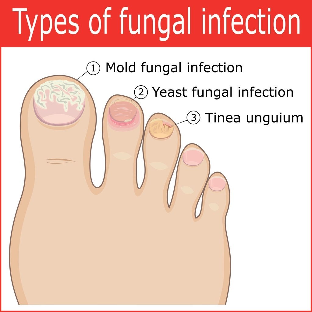 Signs and Symptoms of Fungal Nail Infections