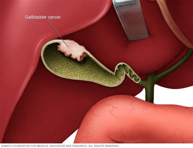 Signs and Symptoms of Gallbladder Cancer