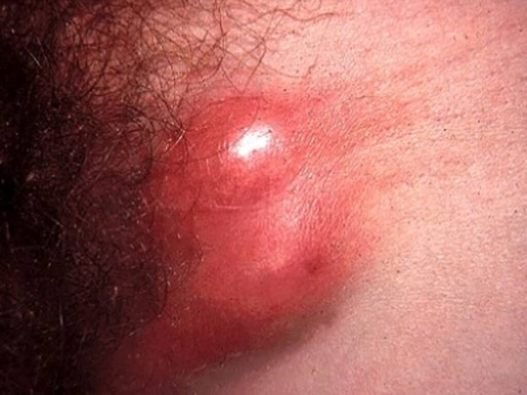 Signs and Symptoms of Lymphogranuloma Venereum (LGV)