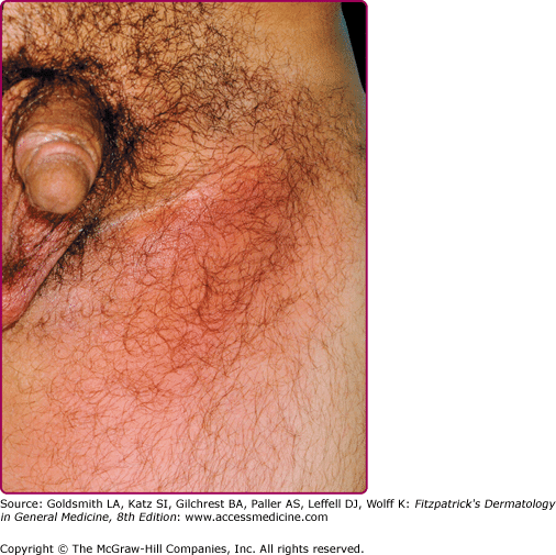 Signs and Symptoms of Lymphogranuloma Venereum (LGV)