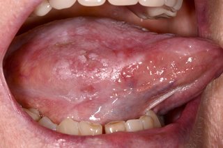 Signs and Symptoms of Mouth Cancer