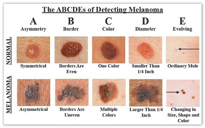 Skin Cancer and Melanoma: A Comprehensive Guide