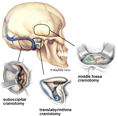 Surgical Options for Acoustic Neuroma Removal