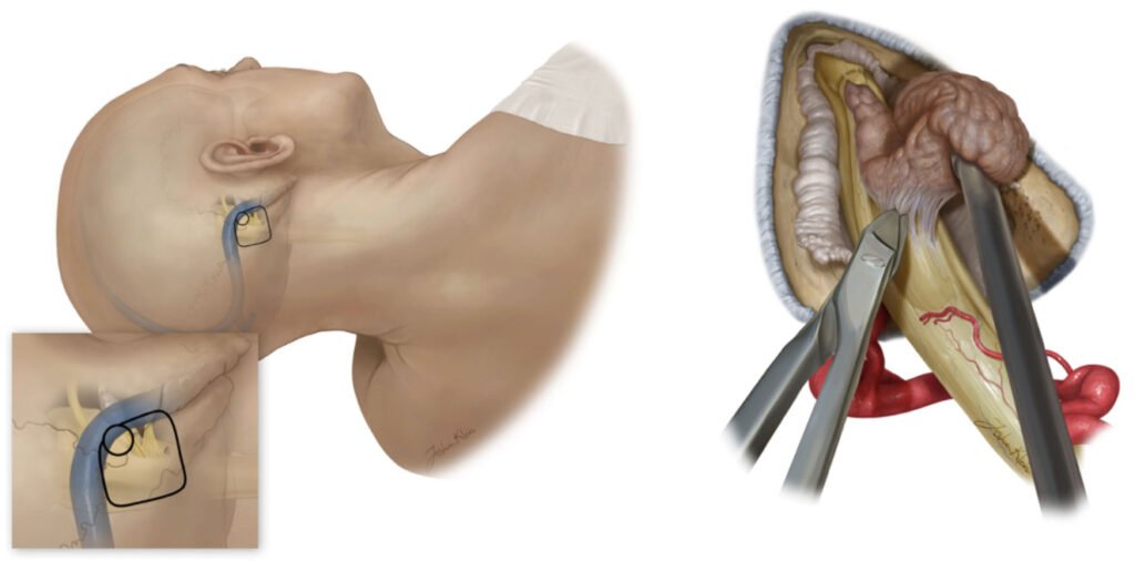 Surgical Options for Acoustic Neuroma Removal