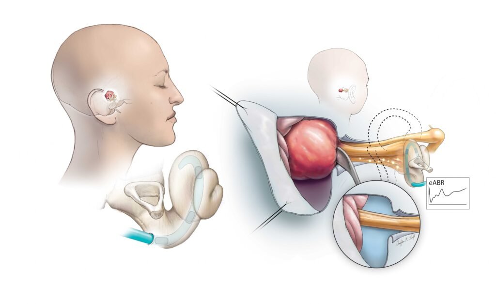 Surgical Options for Acoustic Neuroma Removal