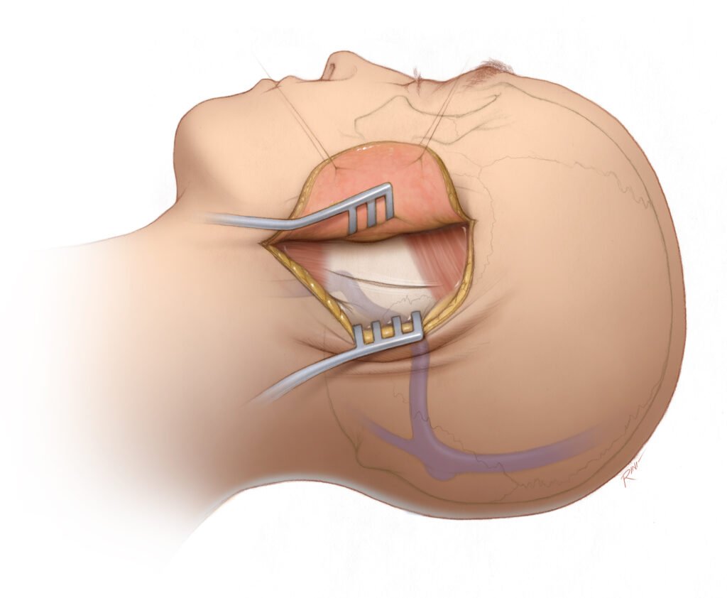 Surgical Options for Acoustic Neuroma Removal