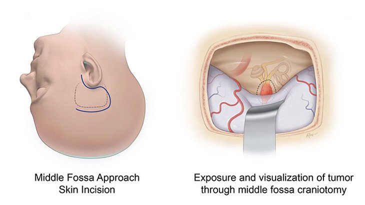 Surgical Options for Acoustic Neuroma Removal