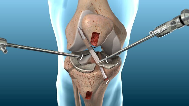 Surgical Options for Anterior Cruciate Ligament (ACL) Injuries