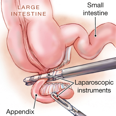 Surgical Options for Appendicitis Treatment