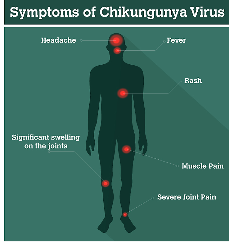 Symptoms and Diagnosis of Chikungunya Virus Disease