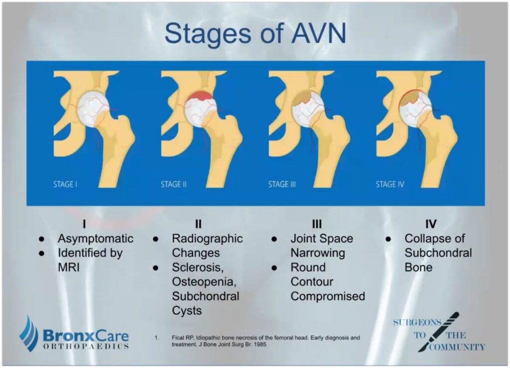 Symptoms And Treatment Of Avascular Necrosis Ask The Nurse Expert